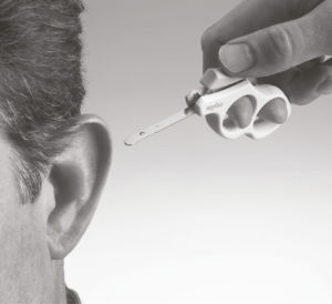 Earfold pour les oreilles décollées à Marseille - Chirurgie esthétique